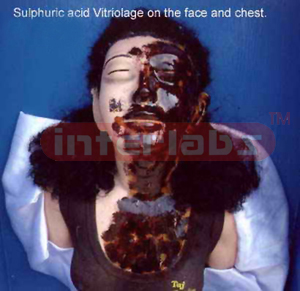 Vitriolage - Sulphuric acid burns on head and face